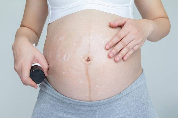 Co na rozstępy po porodzie warto wypróbować?